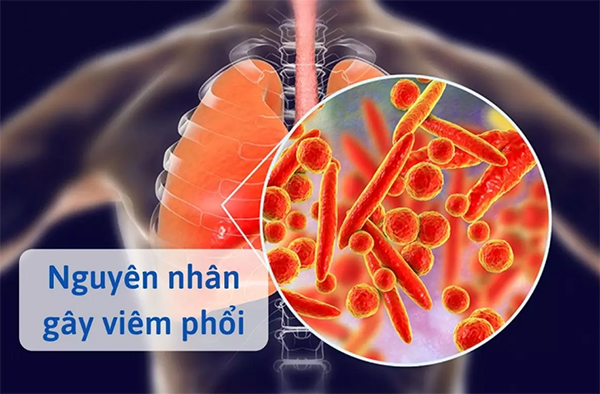 Có rất nhiều nguyên nhân dẫn đến viêm phổi ở người trưởng thành
