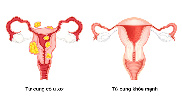 Sự khác biệt giữa tử cung có u xơ và tử cung khỏe mạnh