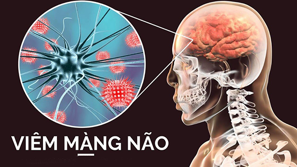 Bệnh viêm màng não gây hậu quả nghiêm trọng đến người bệnh