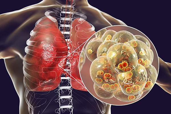Tình trạng của bệnh viêm phổi của người bệnh