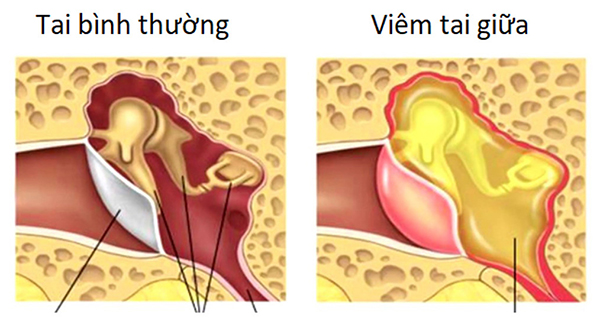 Sự khác biệt giữa tai bình thường và tai bị viêm tai giữa