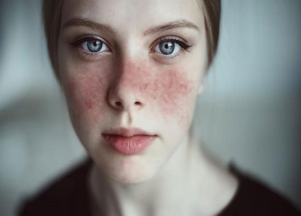 Những biến chứng của bệnh lupus ban đỏ