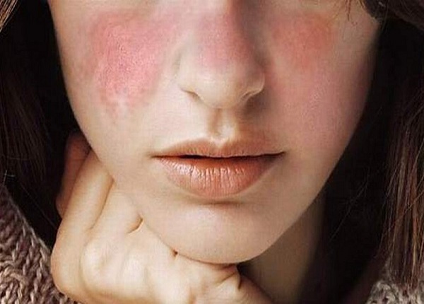 Lupus ban đỏ hệ thống là bệnh lý tự miễn và ảnh hưởng đến nhiều cơ quan trong cơ thể